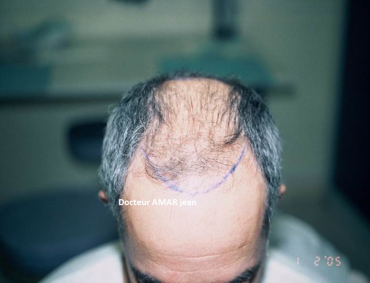 greffe de cheveux