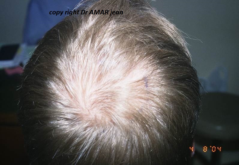 greffe de cheveux