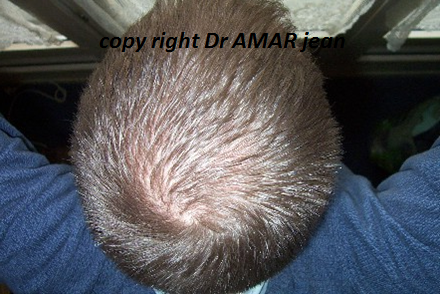 greffe de cheveux