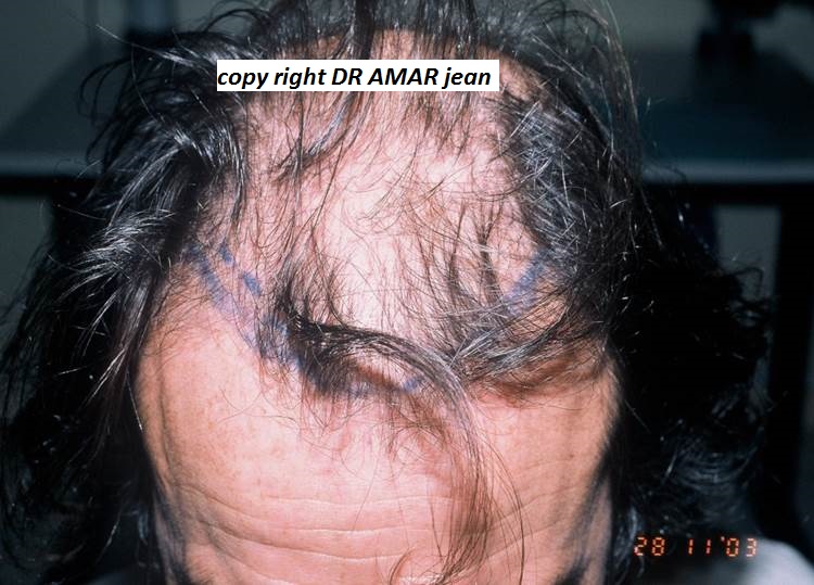 greffe de cheveux