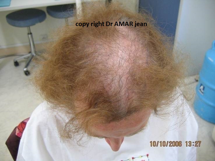 greffe de cheveux