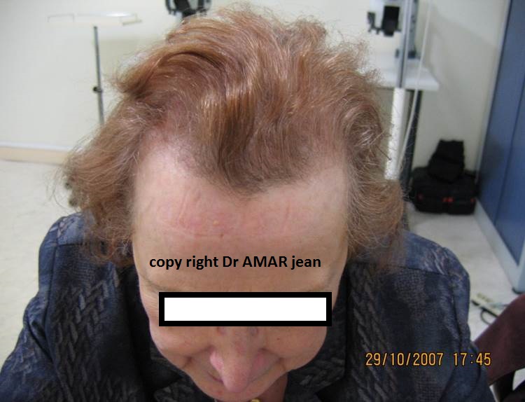 greffe de cheveux