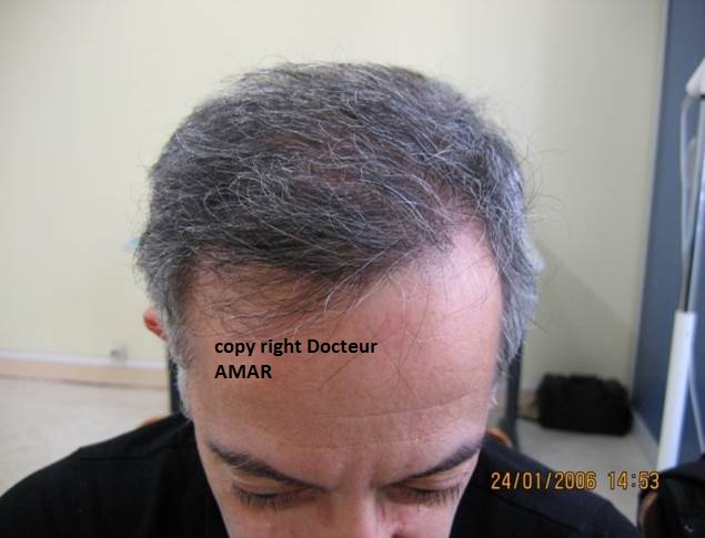 grffe de cheveux