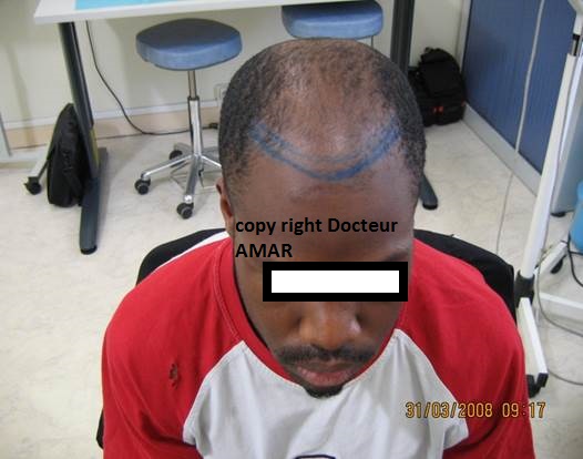 greffe de cheveux