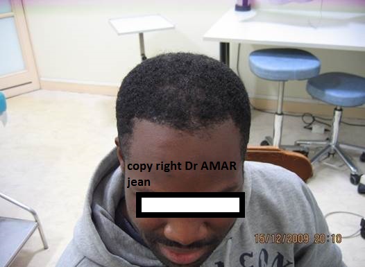 greffe de cheveux