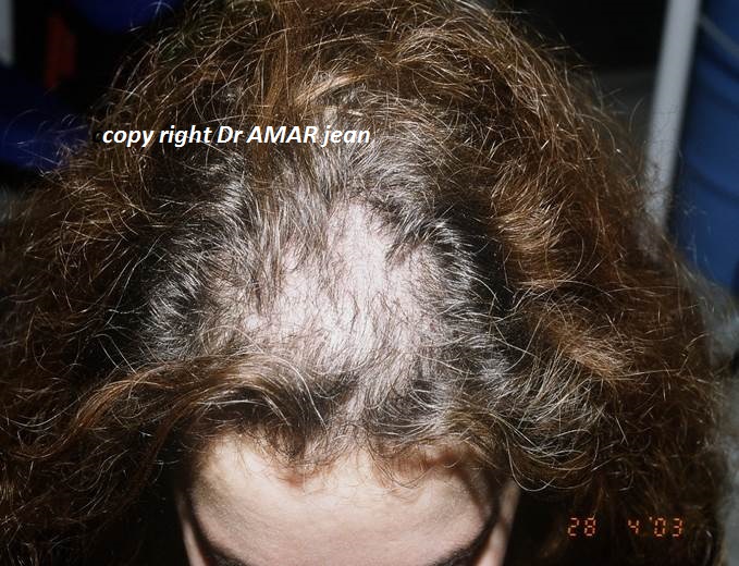 greffe de cheveux