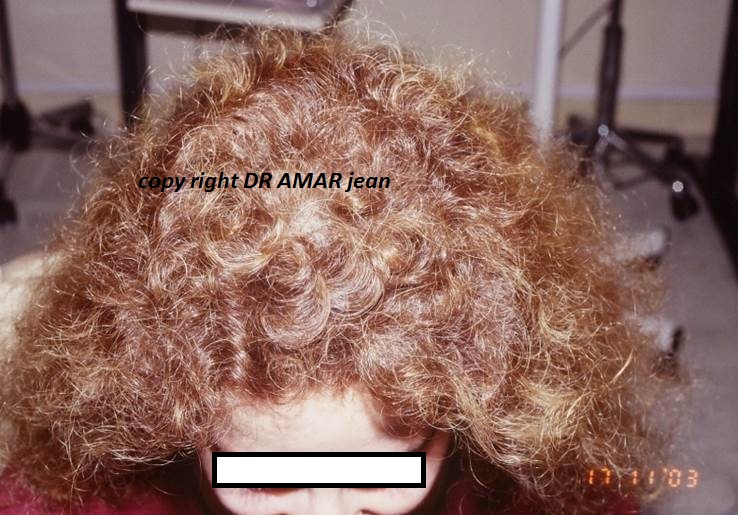 greffe de cheveux